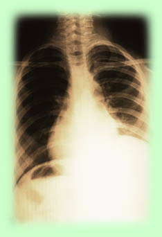x-ray of heart in chest