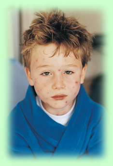 Child with chickenpox