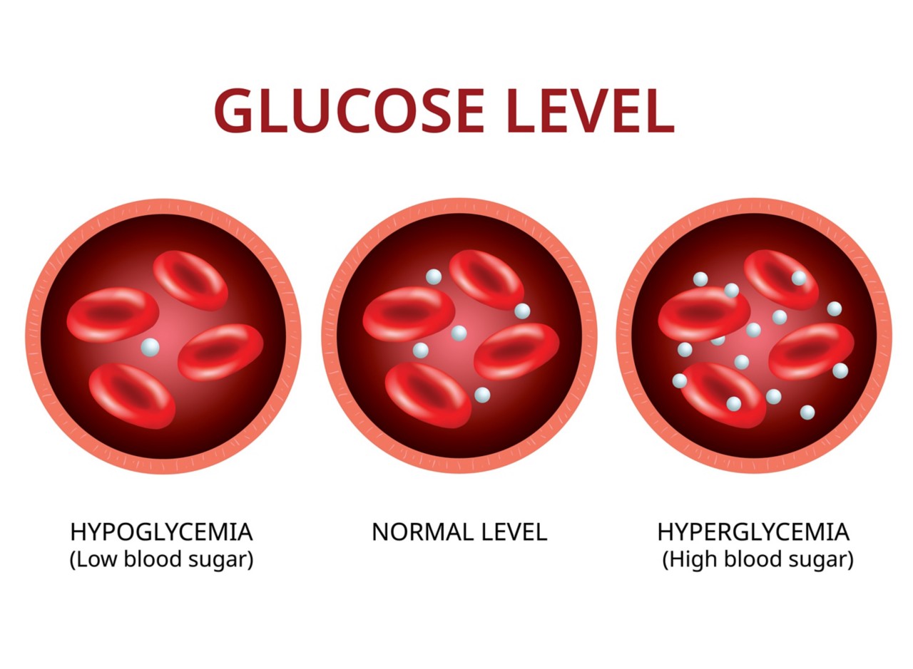 glucose level graphic showing hypoglycemia (low blood sugar), normal level, and hyperglycemia (high blood sugar)