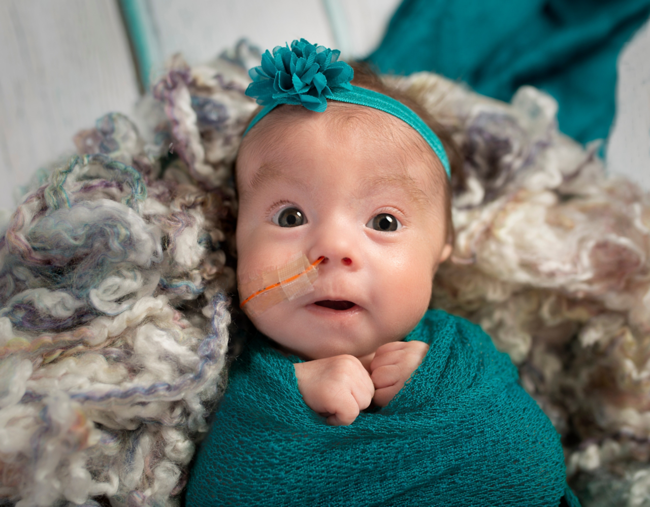 Adorable tiny three month old Trisomy 18 special needs infant girl with nasogastric tube for feeding